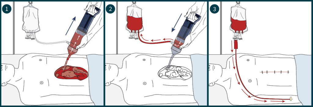 hemafuse how it works